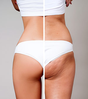 Cellulite - Before And After
