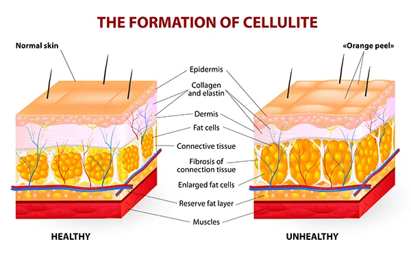 diagram showing normal skin and skin with cellulite with labels