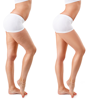 picture of two womens legs one with cellulite and one without
