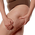 image of woman who os grabbing her legs with cellulite