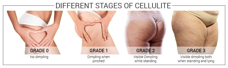 ltimeline of the different stages of cellulite with images