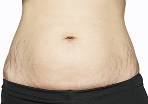 photograph of womans stomach and hips which have stretch marks